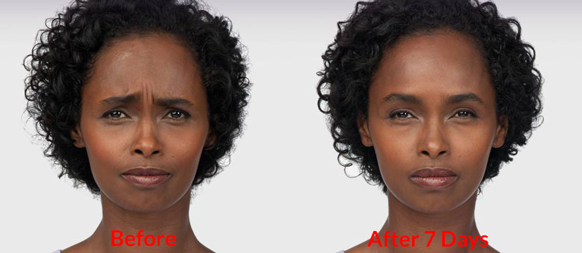 Botox Treatment, Dallas TX Skin Tightening Treatment, Facial Treatment